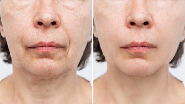 Before and After result G